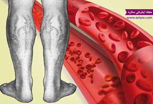بیماری واریس چیست؟