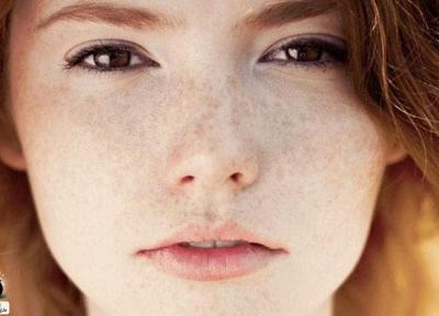 درمان های خانگی برای رفع کک و مک