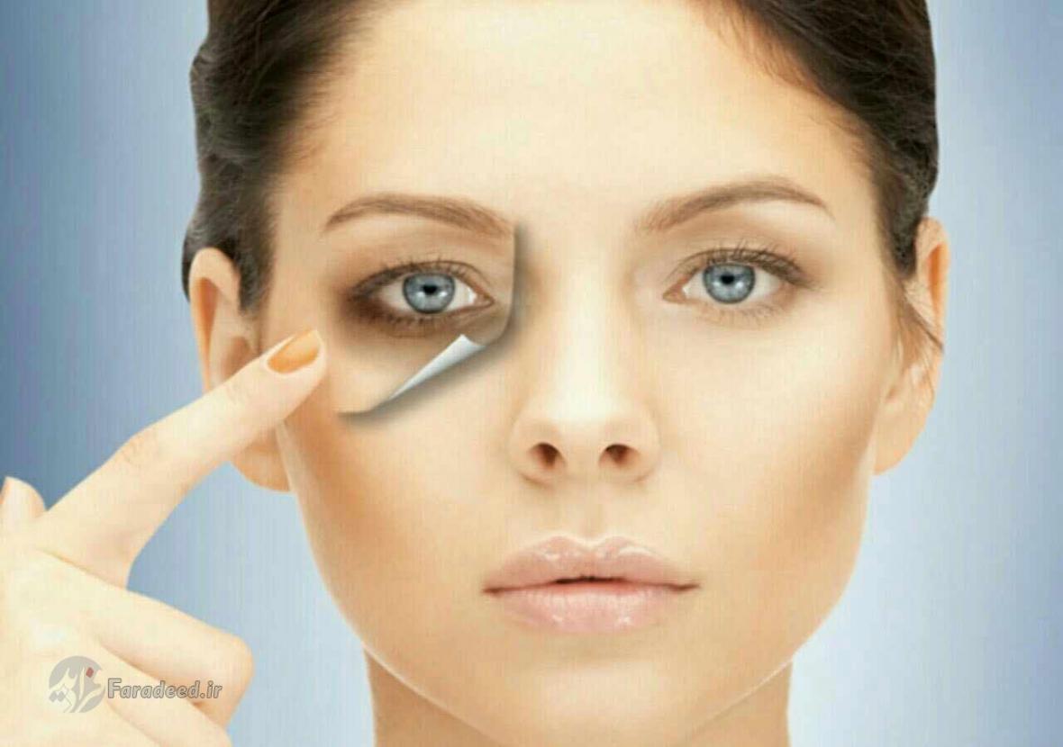 کاهش گودی و سیاهی زیر چشم با ترک 6 عادت