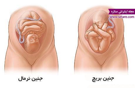 جنین بریچ به چه معناست