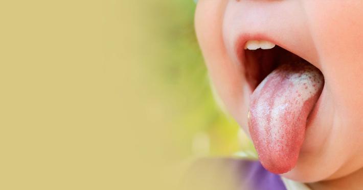 برفک دهان نوزاد چیست و چگونه بفهمیم نوزاد مبتلا به برفک شده؟ برفک دهان نوزاد چیست و چگونه بفهمیم نوزاد مبتلا به برفک شده؟