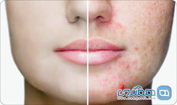 چرا صورت نوجوانان جوش می زند و چه باید بکنیم؟