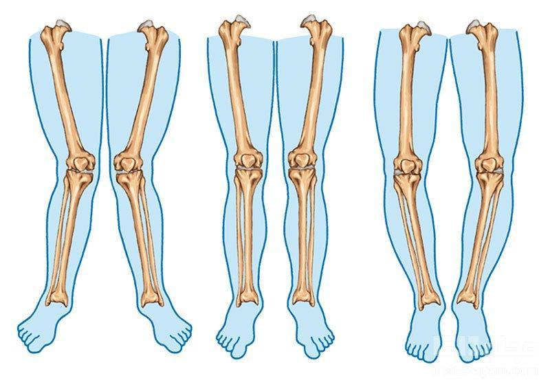 پای پرانتزی، علل و روش های درمان
