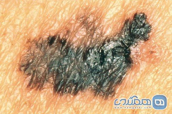 کدام خال ها نشانه سرطانند؟