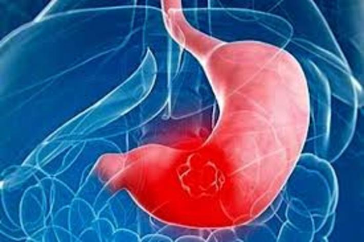 درمان خون ریزی گوارشی درمان خون ریزی گوارشی