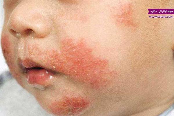 اگزما چیست ؟ + علل و عوامل پیدایش اگزما