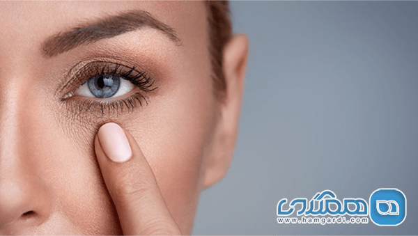 6 علت تیرگی زیر چشم ها