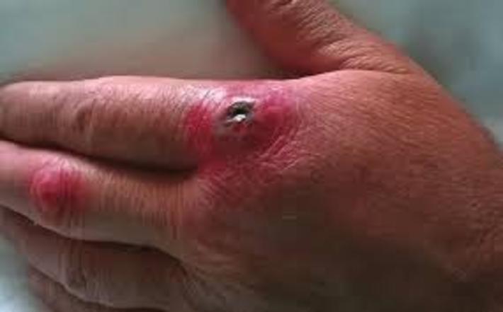 سیاه زخم سیاه زخم