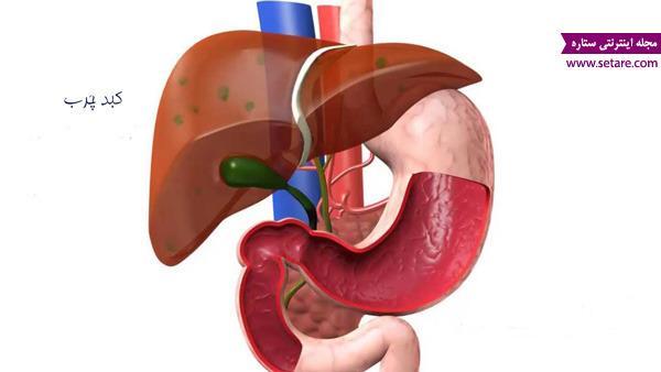 بیماری کبد چرب ؛ علائم، عوارض و درمان