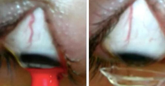 رباتی که با فرمان صوتی لنزها را از چشم جدا می کند