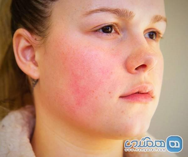 بیماری رزاسه، نشانه ها و روش های پیشگیری بیماری رزاسه، نشانه ها و روش های پیشگیری