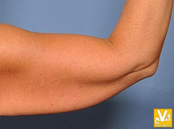 موثرترین روشهای مقابله با افتادگی پوست بعد از کاهش وزن