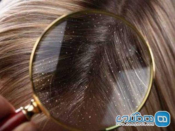 چند راه آسان طب ایرانی برای از بین بردن شوره سر