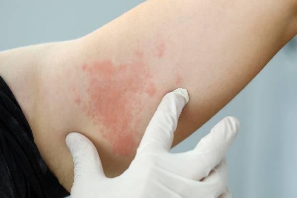 وقتی کهیر و آنژیوادم دارید اما خبر ندارید