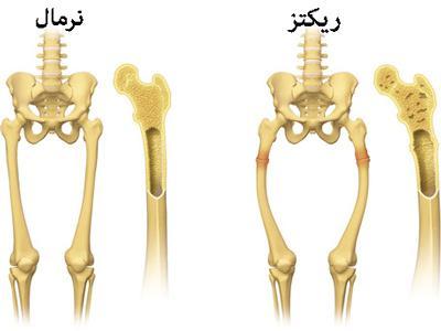 رفع کمبود ویتامین D: راهکارهای جامع جهت حفظ سلامت استخوان ها و تقویت سیستم ایمنی