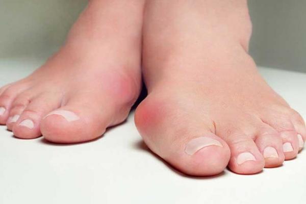 انحراف انگشت شست پا را چگونه درمان کنیم؟