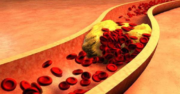 قرص رزوواستاتین؛ موثر در کاهش چربی خون