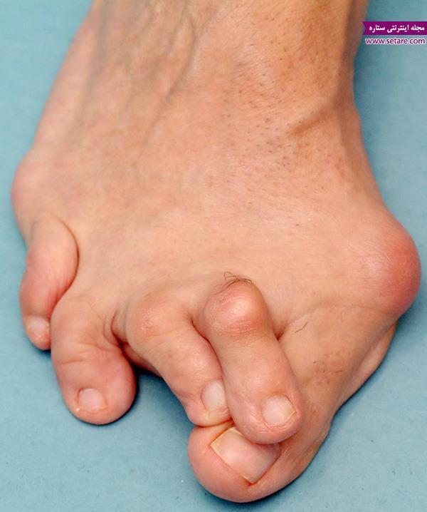 علائم و روش درمان بیماری روماتیسم مفصلی