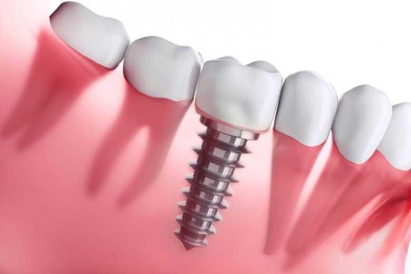 بعد از انجام عمل جراحی ایمپلنت چگونه از جایگزین دندان هایمان به درستی حفاظت کنیم؟