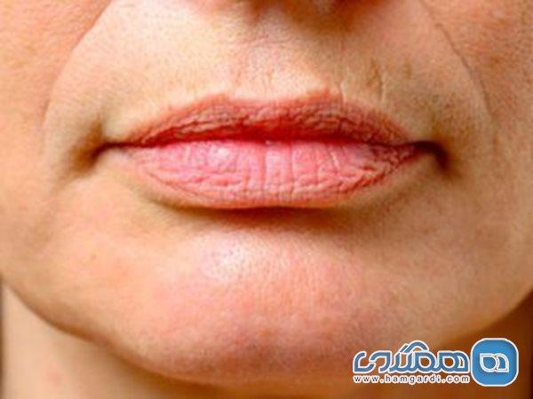 پیشگیری از چروک شدن دور لب با چند راه چاره ساده