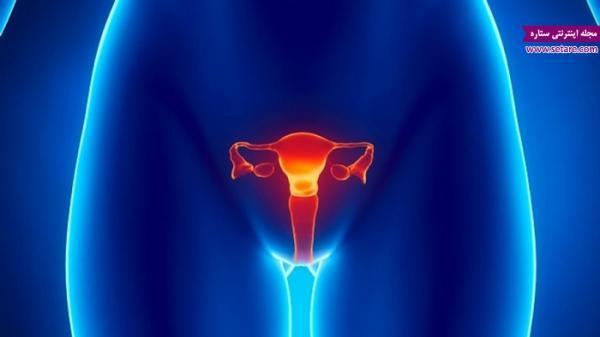 علائم کیست تخمدان چیست؟