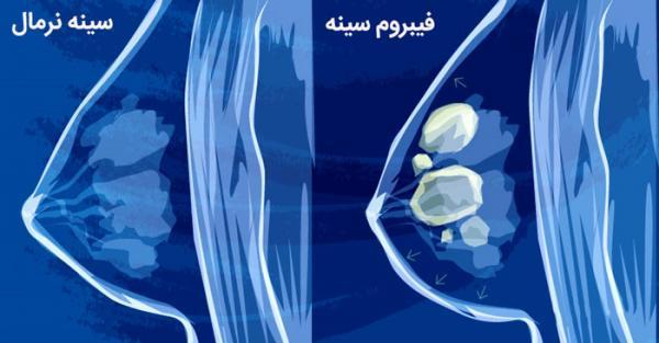 فیبروم سینه چیست؟
