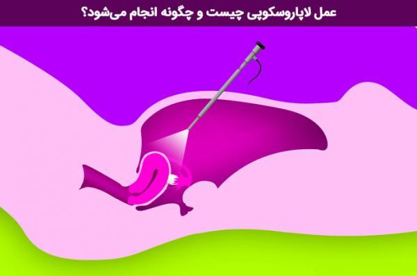عمل لاپاراسکوپی چیست و چگونه انجام می شود؟ عمل لاپاراسکوپی چیست و چگونه انجام می گردد؟