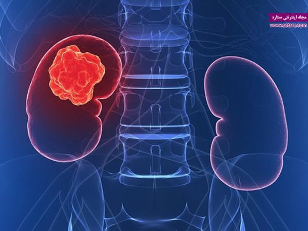 علائم سرطان کلیه چیست؟