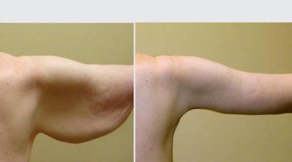 چه روش هایی برای لیفت بازو وجود دارد؟