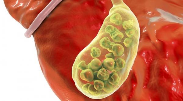 سنگ کیسه صفرا چیست؟