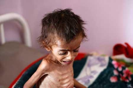 سوءتعذیه شدید نیمی از بچه ها در یمن