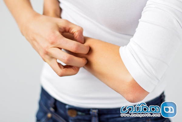 از علت تا درمان کبودی خارش دار