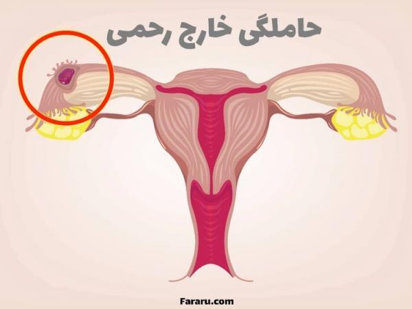 حاملگی خارج رحمی؛ چرا رخ می دهد و چه علائمی دارد؟