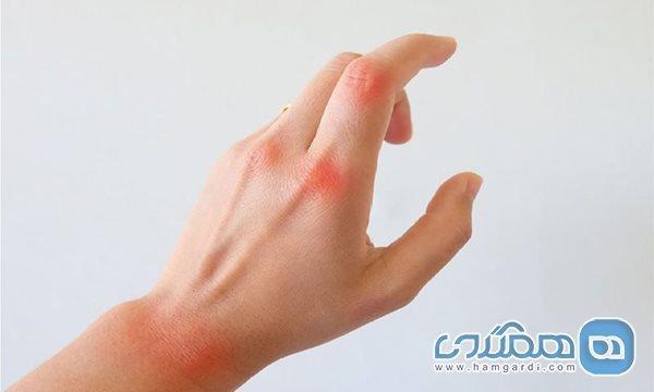پیشگیری از آرتریت با کنترل رژیم غذایی