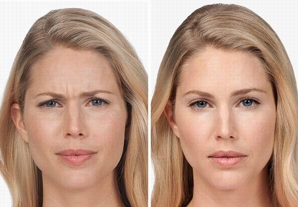 عوارض بوتاکس پیشانی و روش های رفع کردن آن