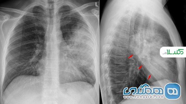 بیماری پنومونیت چیست؟