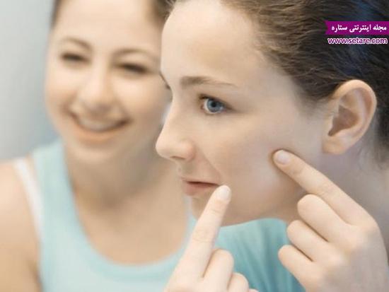 کپسول تتراسیکلین و تاثیر آن در درمان آکنه