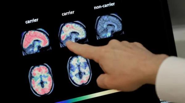 آمریکا؛ تایید داروی آلزایمر پس از 20 سال