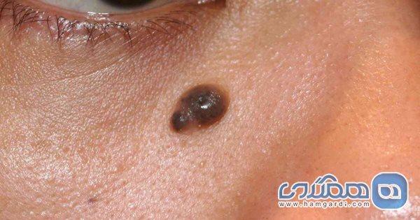 علت خارش خال ، نکاتی مهم در مورد خال ها