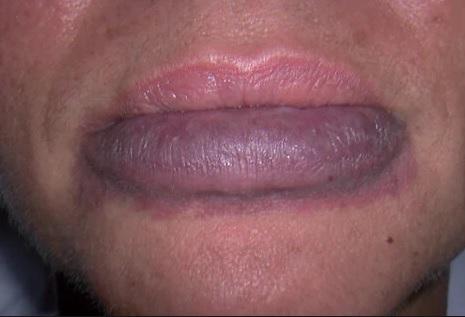 ارتباط انواع بیماری با تغییر رنگ لب ها