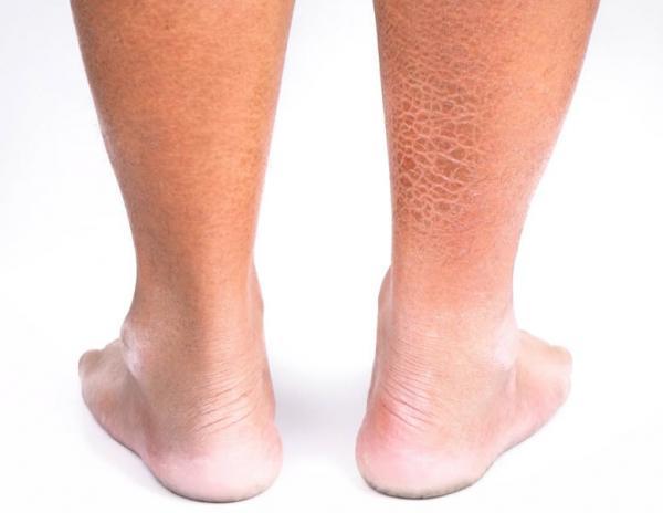 ایکتیوز ولگاریس، بیماری ای که در آن پوست شبیه پوست فلس ماهی ها می گردد