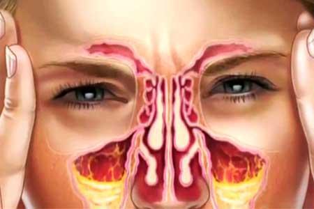 نسخه طب سنتی برای درمان سینوزیت