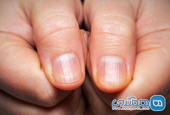 این تغییرات ناخن نشانه دیابت هستند این تغییرات ناخن نشانه دیابت هستند