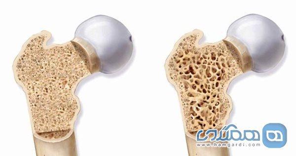 11 نکته درباره پوکی استخوان