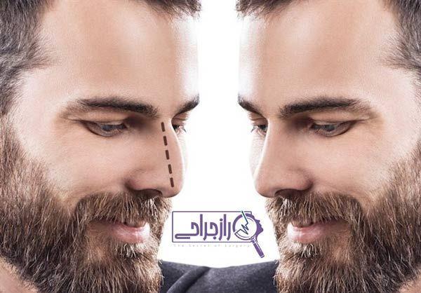 عمل بینی گوشتی و استخوانی بدون بازگشت در راز جراحی