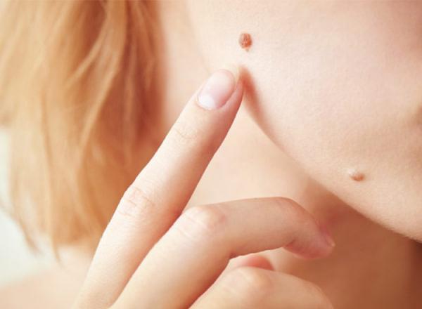 خال خوش خیم و بدخیم چه تفاوتی دارند؟