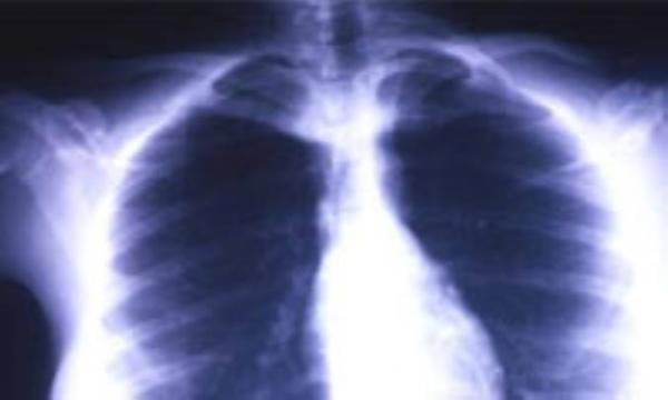 نشانگان انسداد خروجی قفسه سینه *