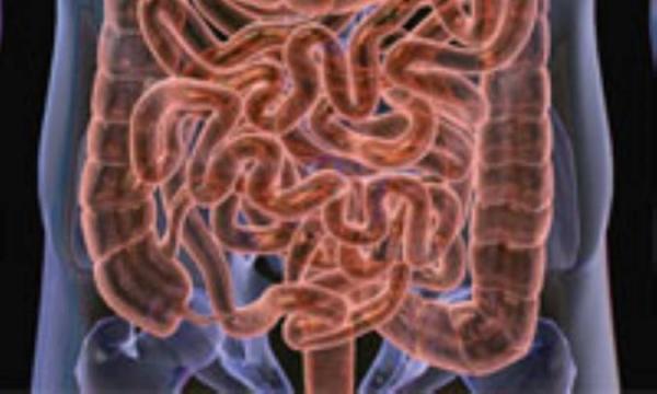 نشانگان روده تحریک پذیر