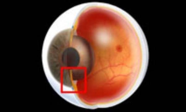 آب سیاه چشم ، نوع زاویه بسته اولیه