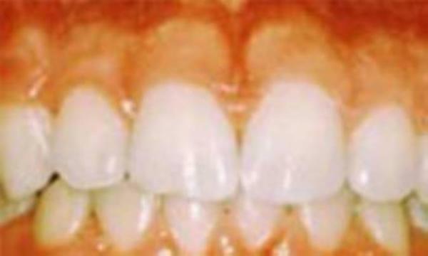 پیشگیری از التهاب لثه و پوسیدگی دندان پیشگیری از التهاب لثه و پوسیدگی دندان